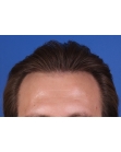 After Hair Transplant &nbsp;2 Sessions (Areas)